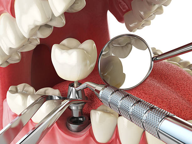 Best Emergency Treatment for Dental Infections or Abscesses in Carey, OH