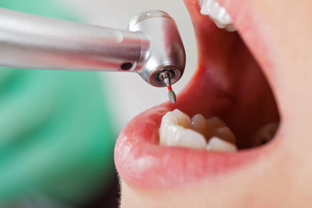 Best Emergency Dental Care for Broken or Chipped Teeth in Carey, OH